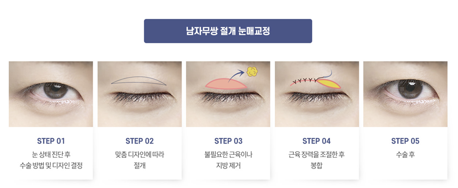 남자 눈성형 설명 도해