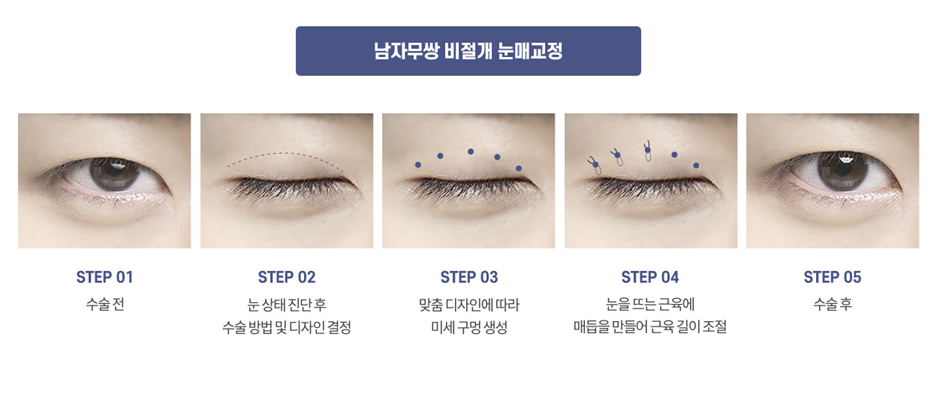 남자 눈성형 설명 도해