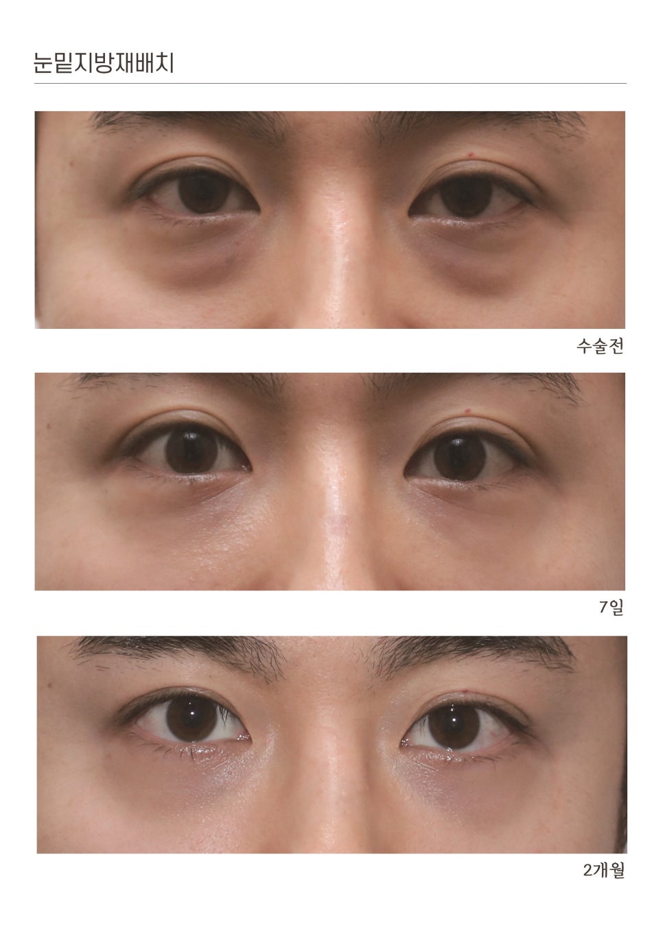 눈밑지방재배치 전후 비교 사진