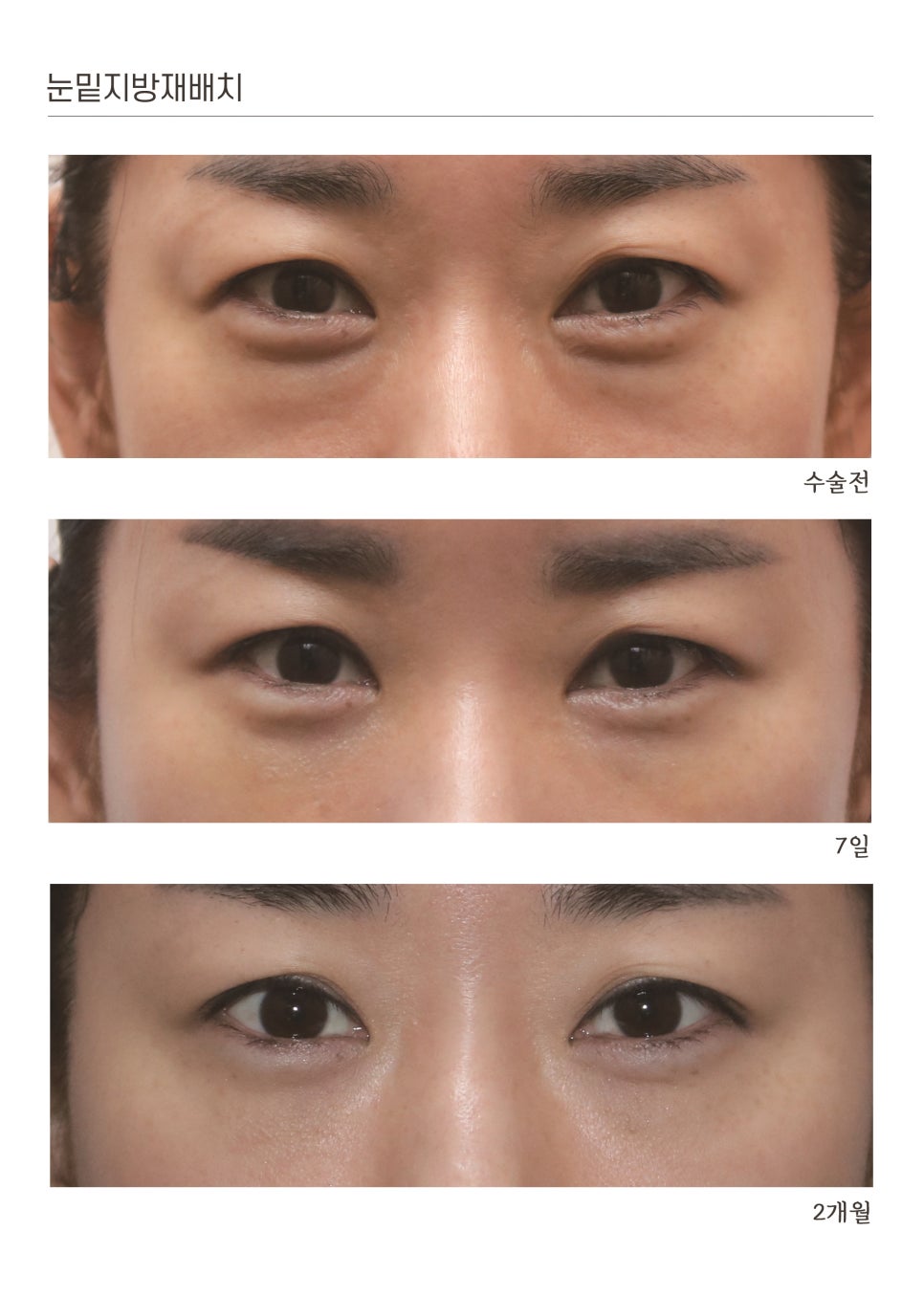 눈밑지방재배치 전후 비교 사진
