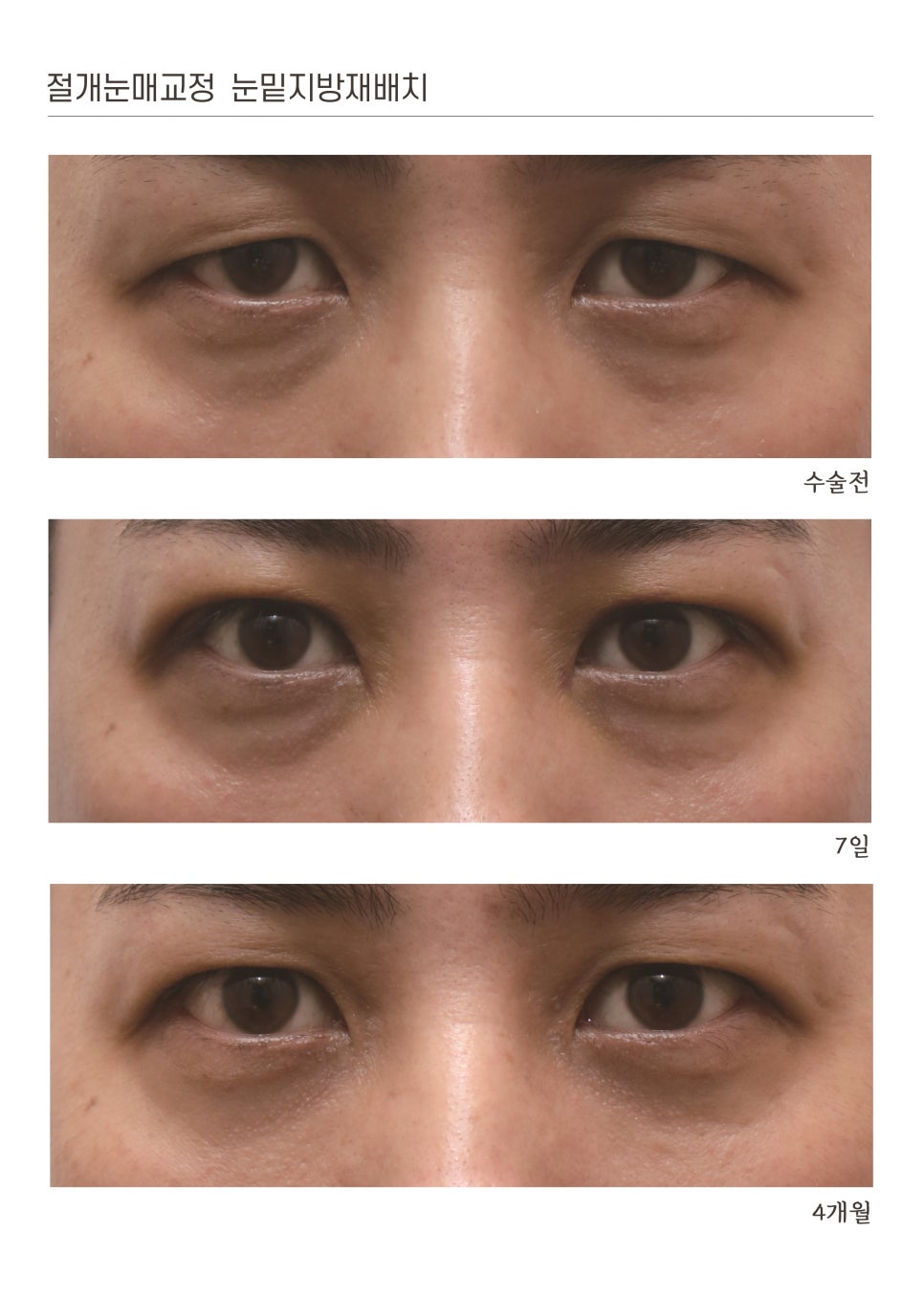 절개눈매교정 눈밑지방재배치 전후 비교 사진