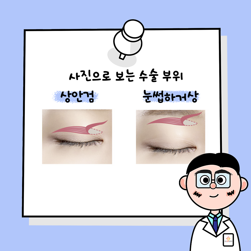 상안검성형 설명 도해