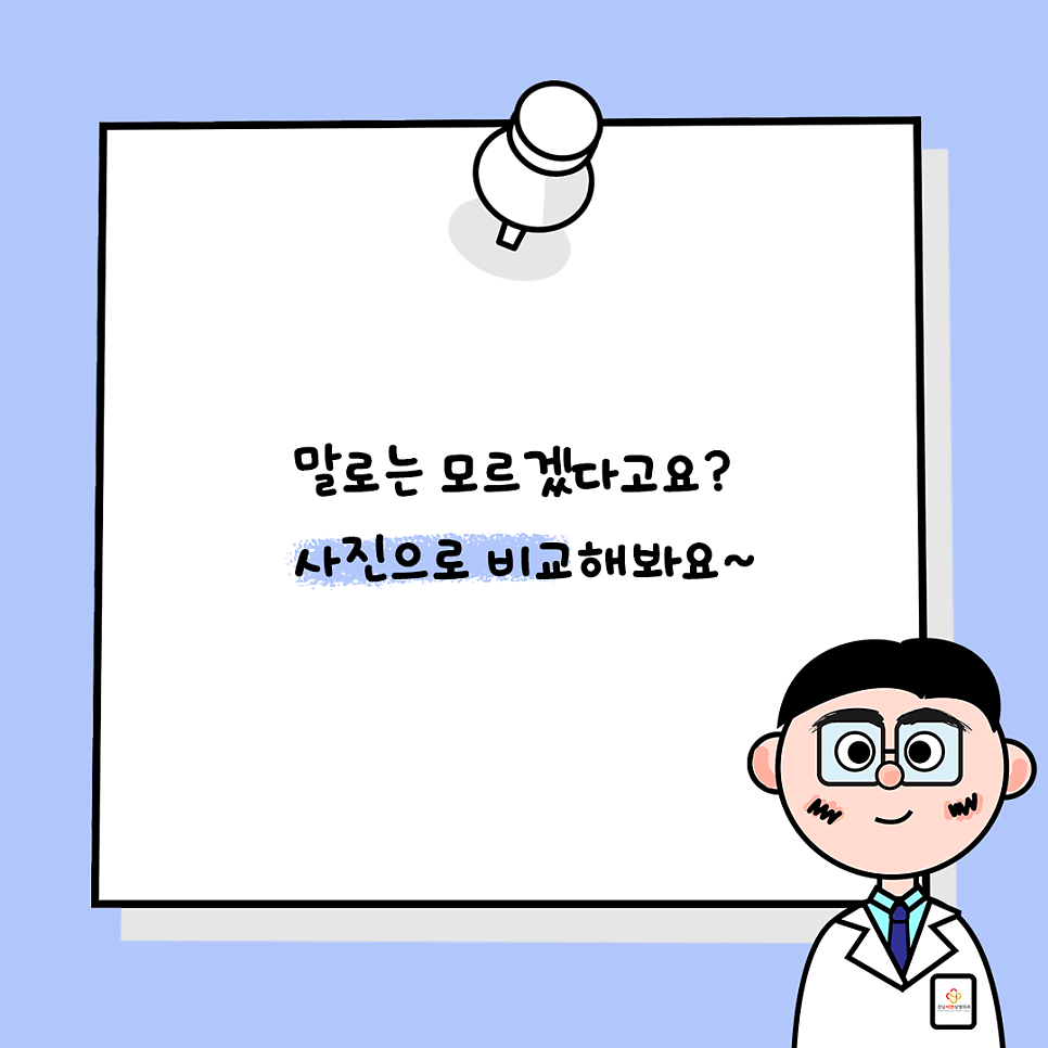 상안검성형 설명 도해