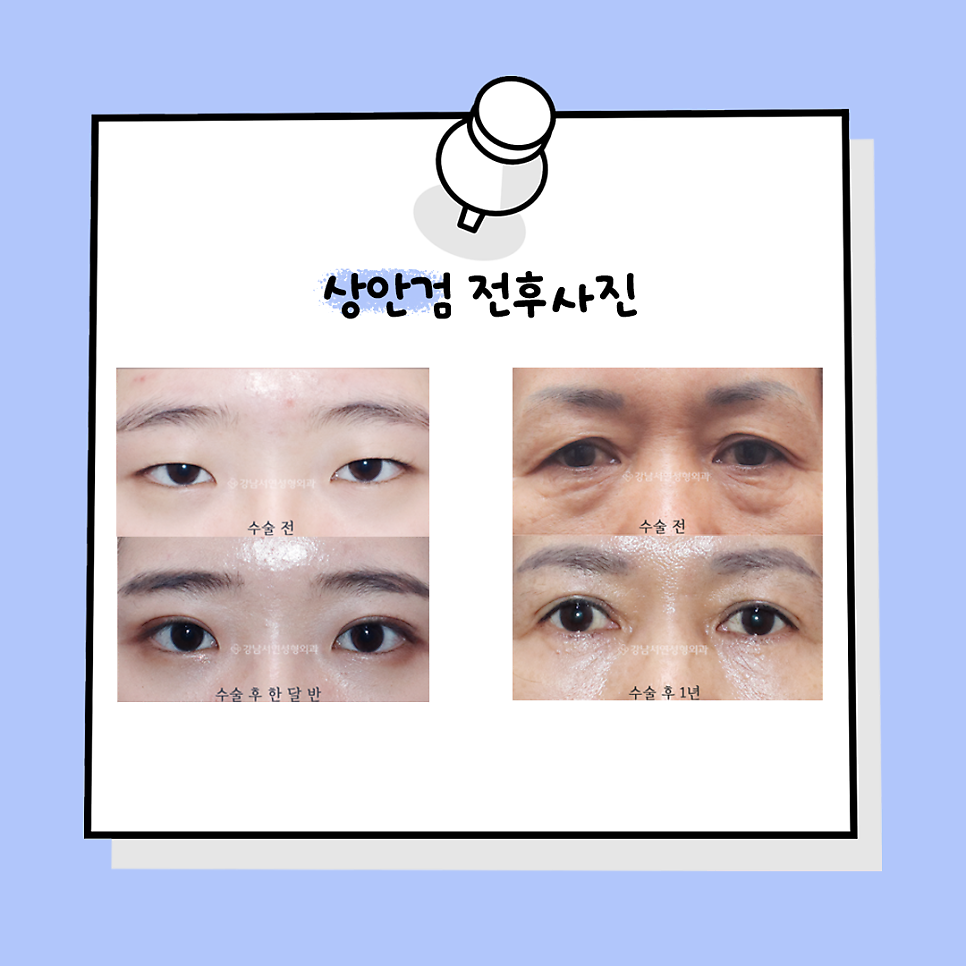 상안검성형 수술 전후 비교 사진