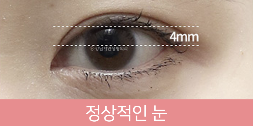 눈매교정 설명 도해