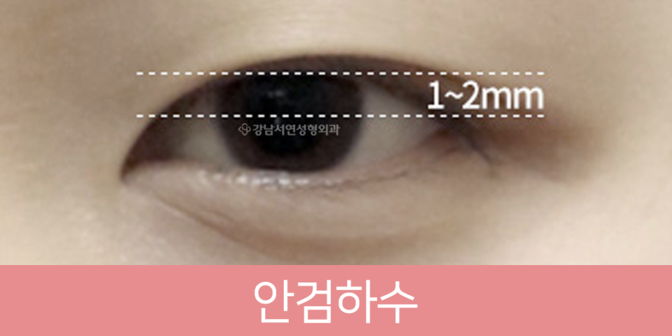 눈매교정 설명 도해