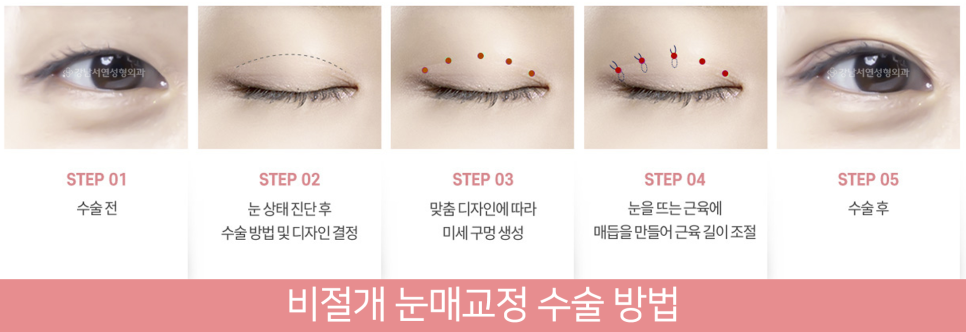 눈매교정 설명 도해