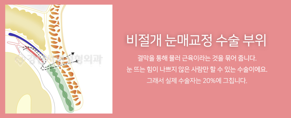 눈매교정 설명 도해