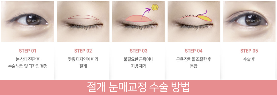 눈매교정 설명 도해