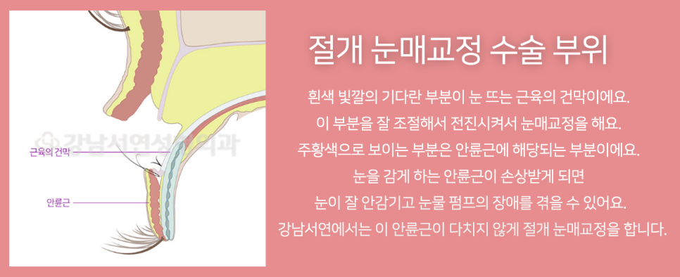 눈매교정 설명 도해