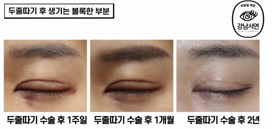 두줄따기 수술 전후 비교 사진