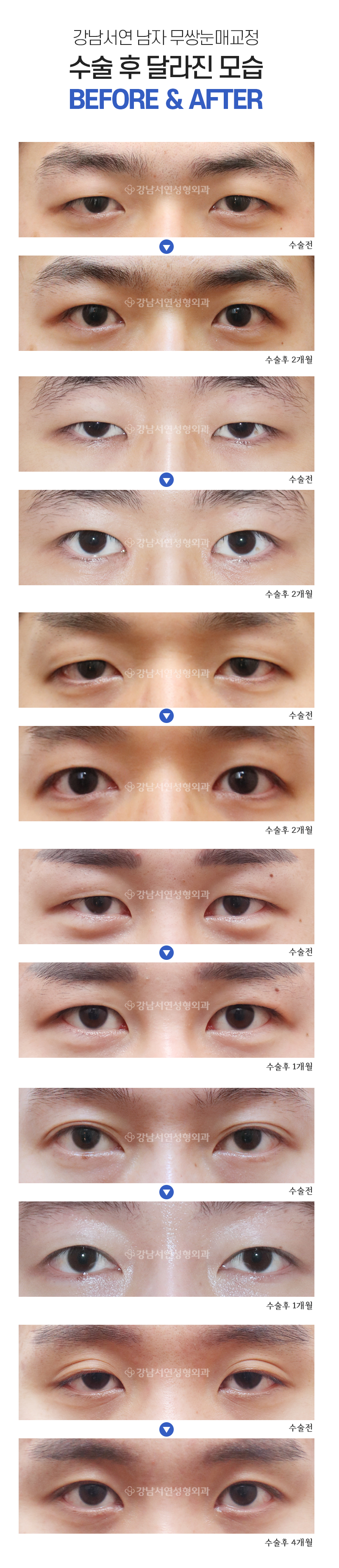 남자 눈성형 수술 전후 비교 사진