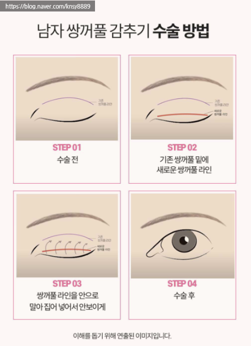 남자 눈성형 설명 도해