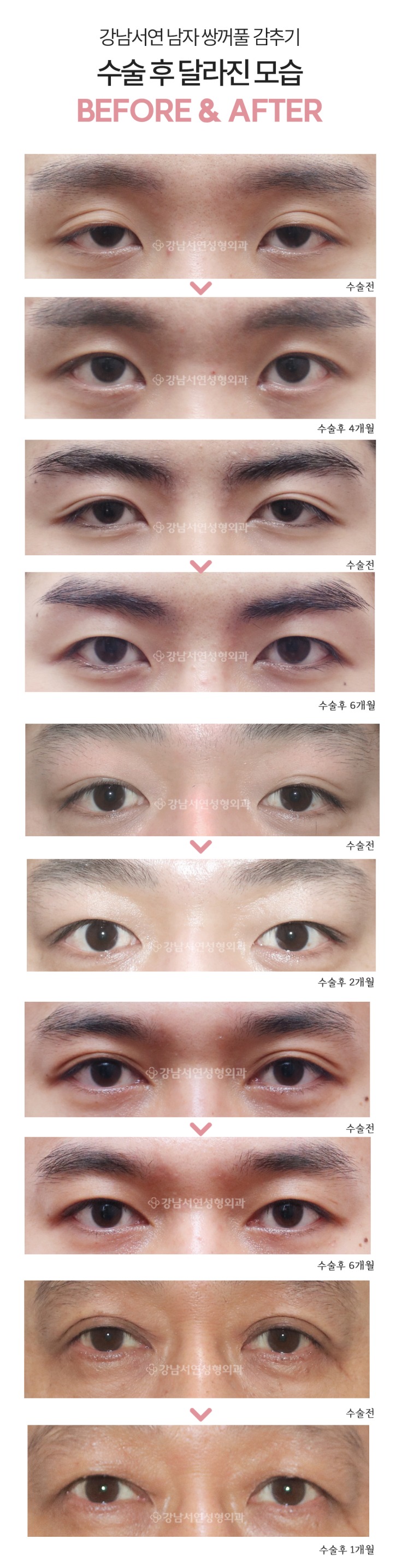 남자 눈성형 수술 전후 비교 사진