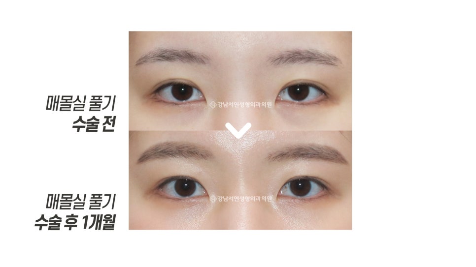 매몰실 풀기 수술 후 1개월 전후 비교 사진
