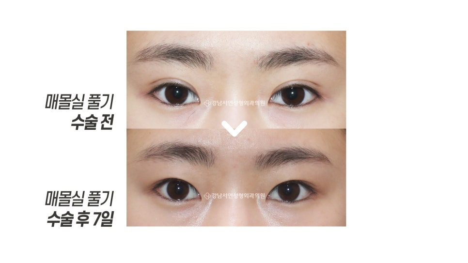 매몰실 풀기 수술 후 7일 전후 비교 사진