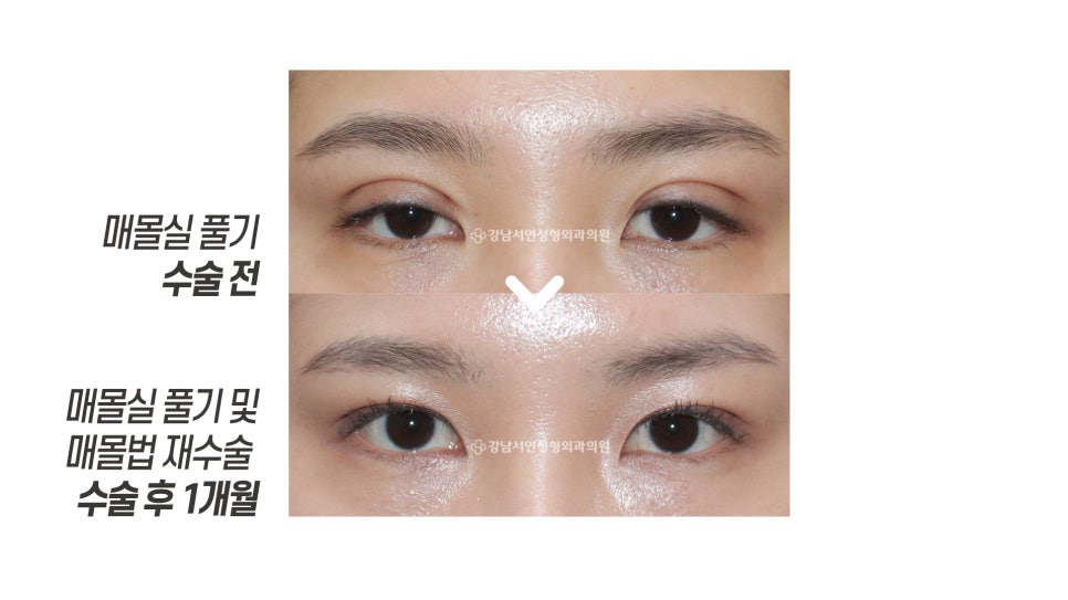 매몰실 풀기 후 매몰법 재수술 1개월 전후 비교 사진