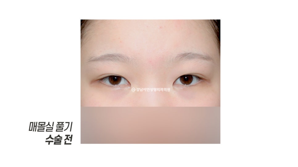 매몰실 풀기 수술 전 사진