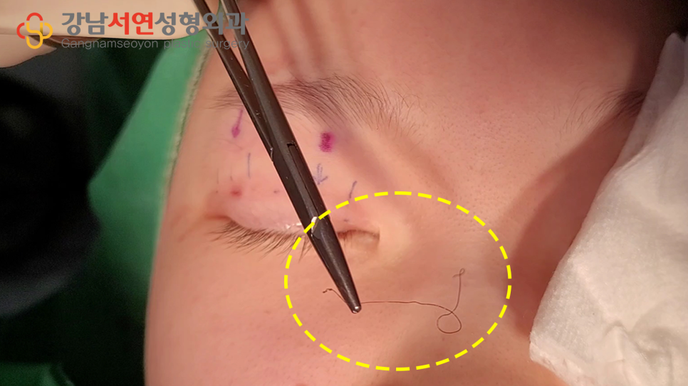 매몰실풀기 수술 장면