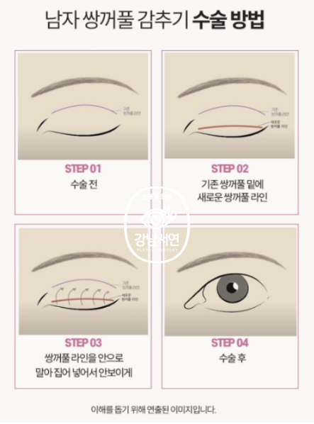 남자 눈성형 설명 도해