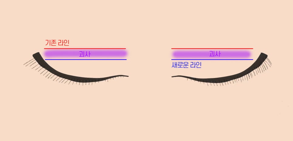 쌍꺼풀 조기재교정 설명 도해