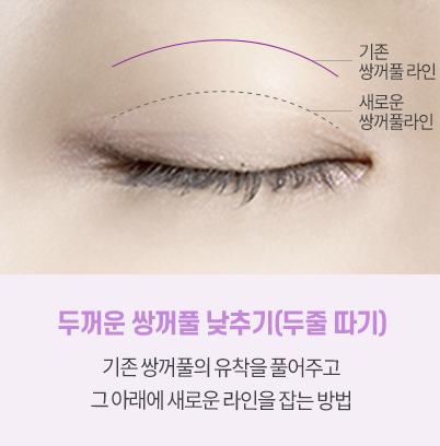 쌍꺼풀 재수술 설명 도해