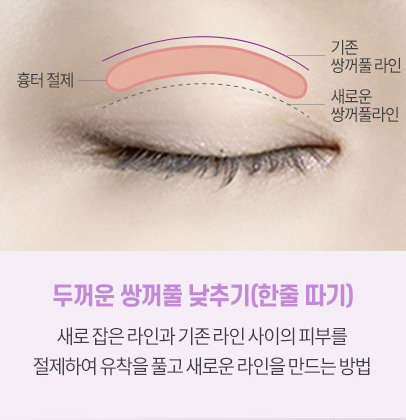 쌍꺼풀 재수술 설명 도해