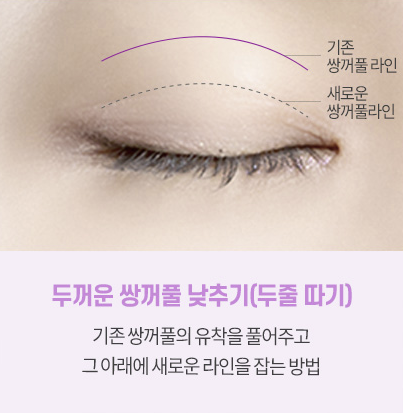 쌍꺼풀 재수술 설명 도해