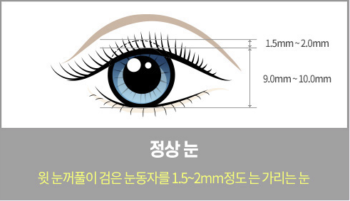 퇴축수술 설명 도해