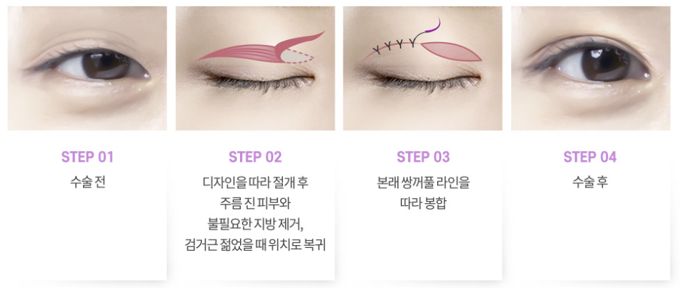 하안검성형 설명 도해