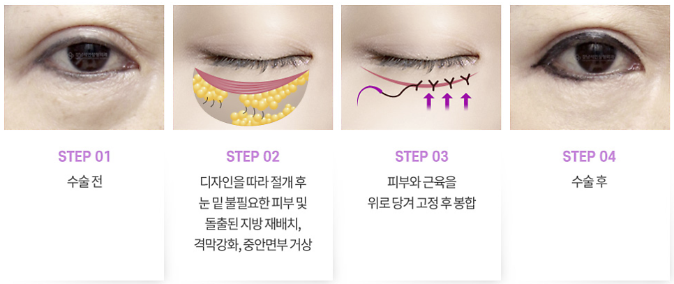 하안검성형 설명 도해