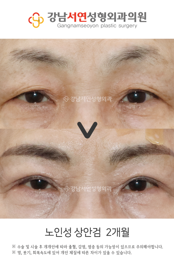 노인성 상안검 2개월 전후 비교 사진