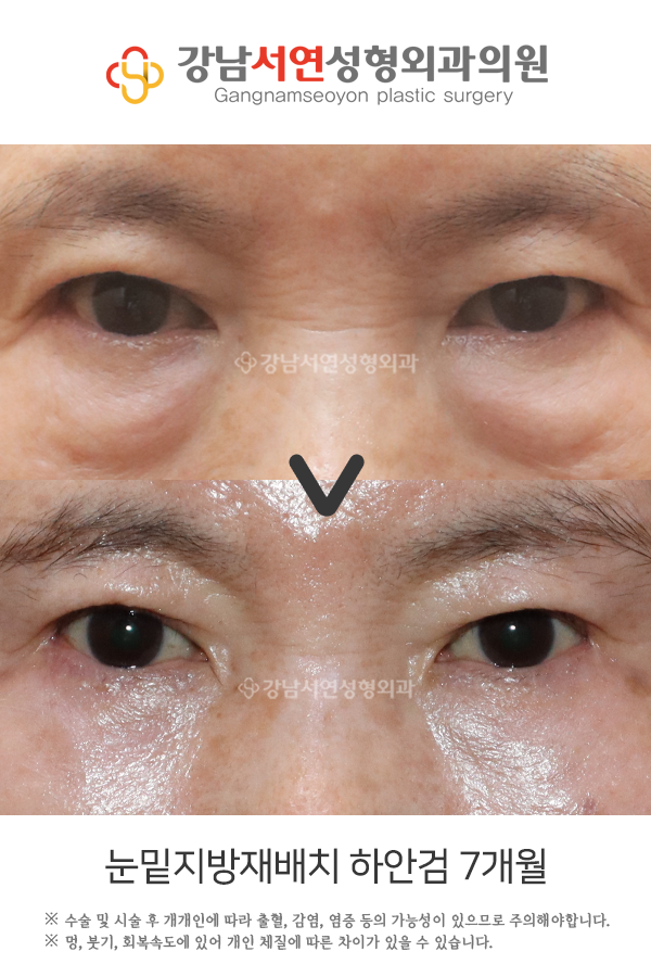 눈밑지방재배치 하안검 7개월 전후 비교 사진