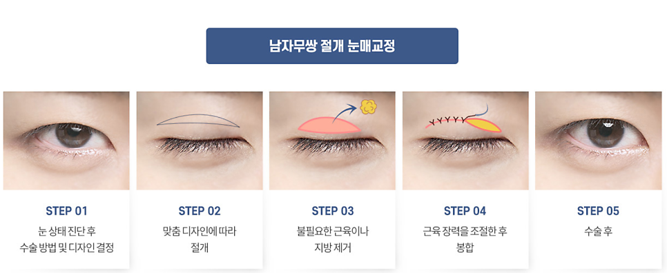 남자 눈성형 설명 도해