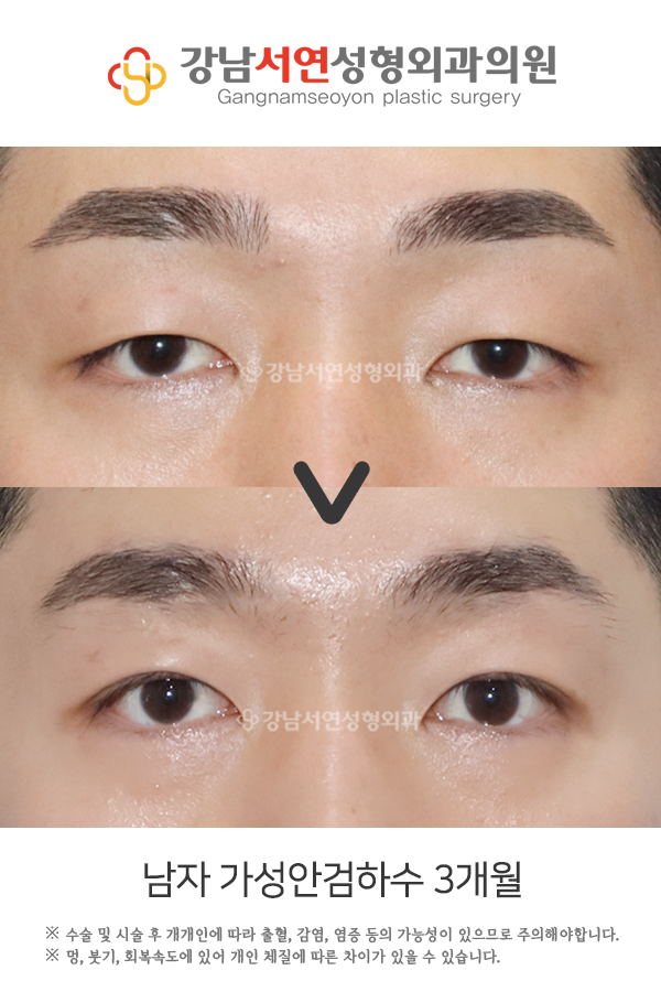 남자 가성안검하수 3개월 전후 비교 사진