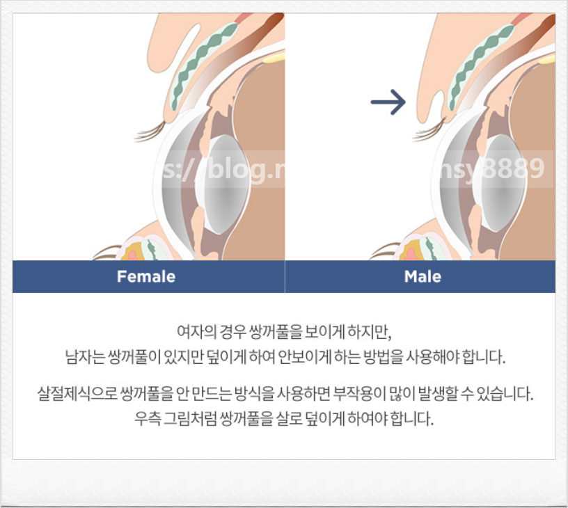 쌍꺼풀 수술 설명 도해