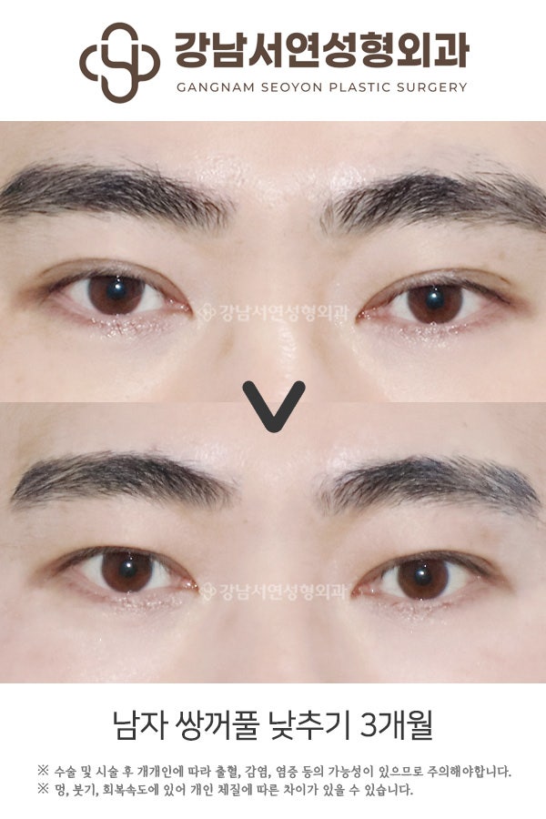 쌍꺼풀 제거 수술 _ 느끼한 눈을 시원하고 담백한 눈으로