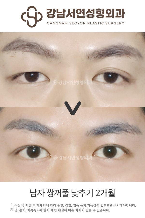 남자 쌍꺼풀 낮추기 2개월 전후 비교 사진