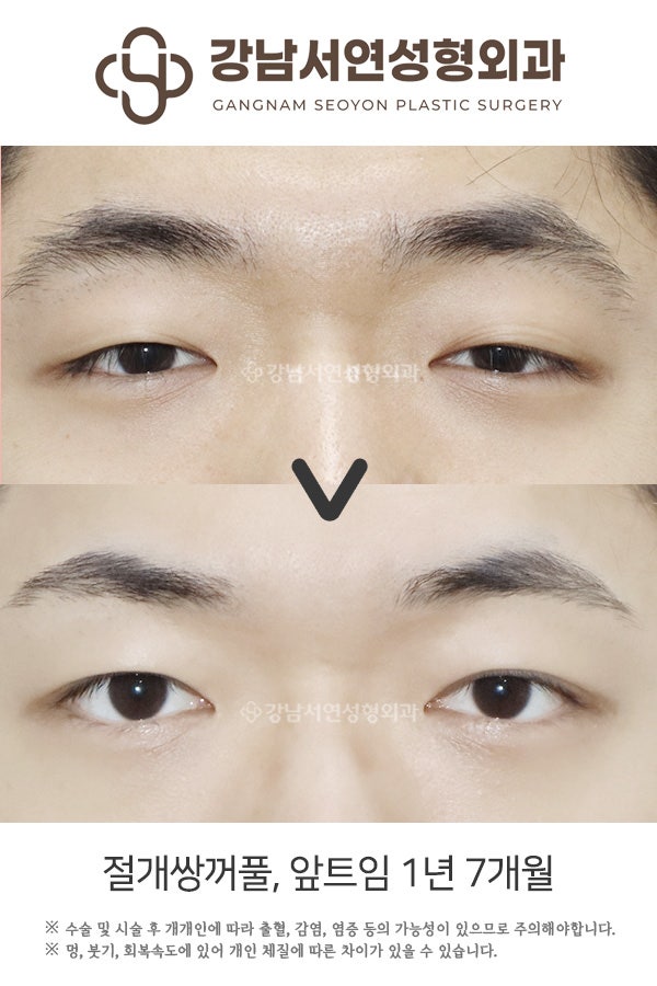 절개쌍꺼풀, 앞트임 1년 7개월 전후 비교 사진