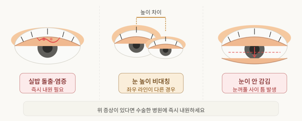 쌍꺼풀 재수술 설명 도해