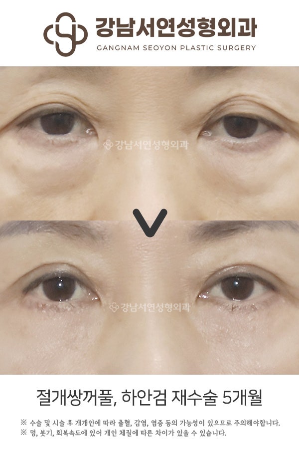 절개쌍꺼풀, 하안검 재수술 5개월 전후 비교 사진