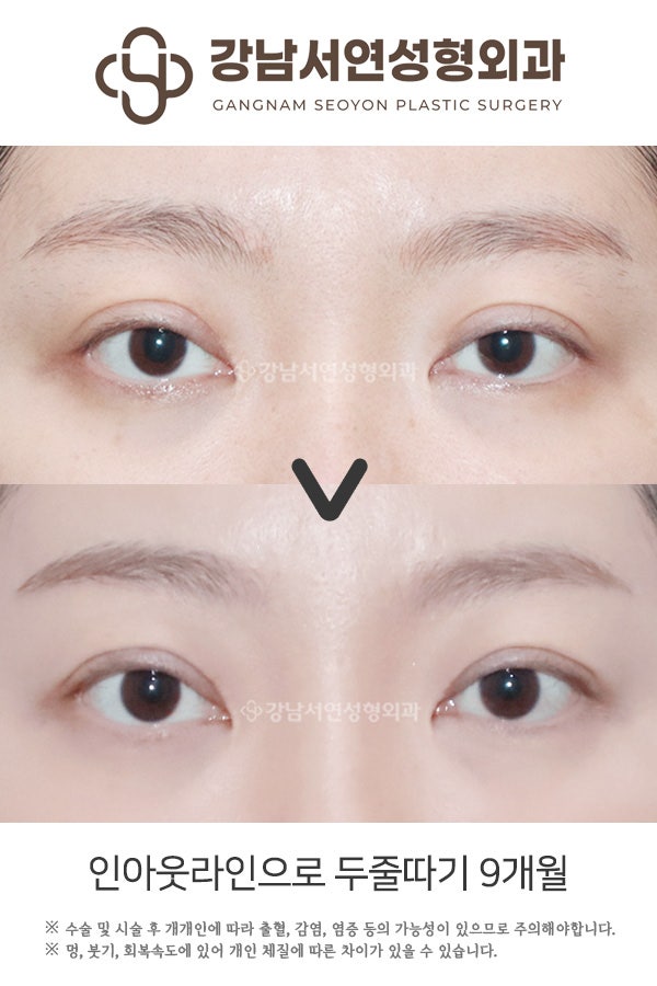 인아웃라인으로 두줄따기 9개월 전후 비교 사진
