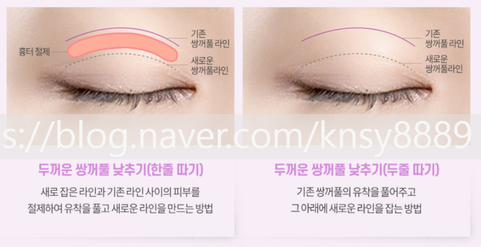 쌍꺼풀 재수술 설명 도해