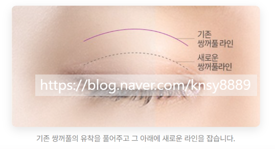 쌍꺼풀 재수술 설명 도해