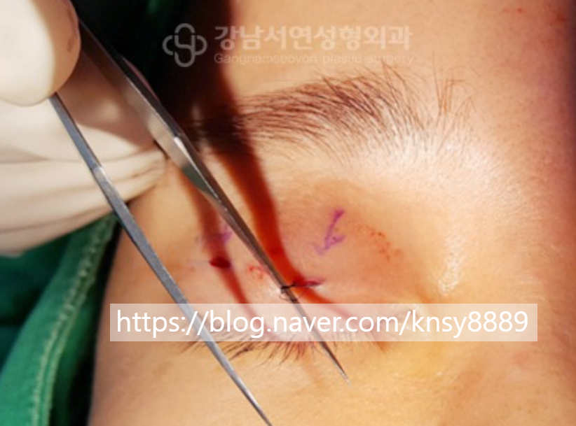 매몰실풀기 수술 장면