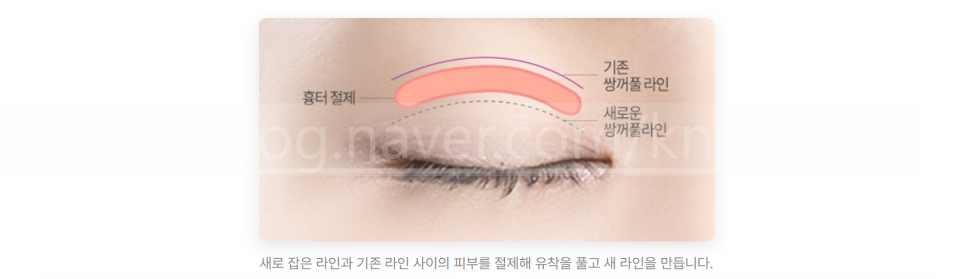 쌍꺼풀 재수술 설명 도해