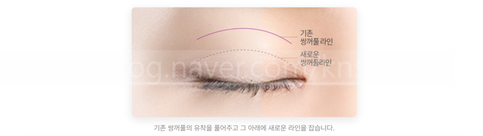 쌍꺼풀 재수술 설명 도해