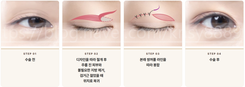 상안검성형 설명 도해