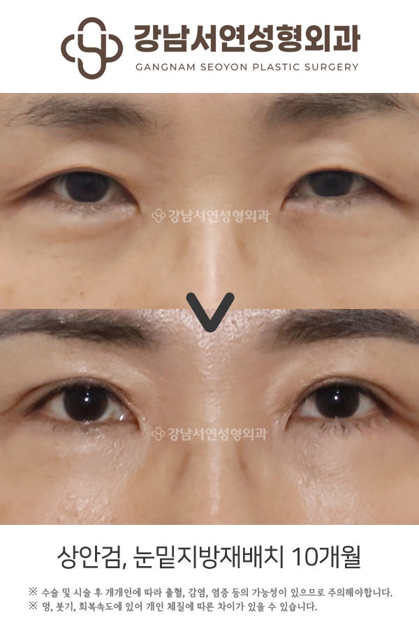 상안검, 눈밑지방재배치 10개월 전후 비교 사진