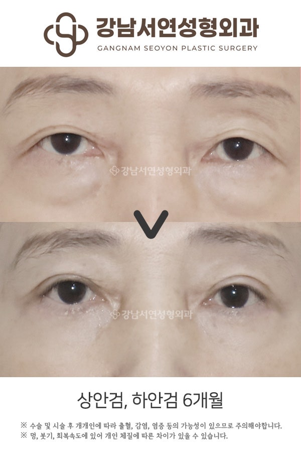상안검, 하안검 6개월 전후 비교 사진